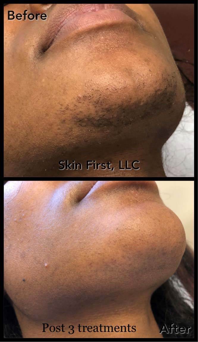 Laser Hair Removal – Skin First